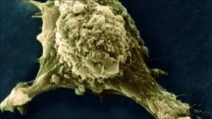 Rakovina a metastázy (2)