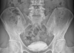 Snímok intravenóznej urografie