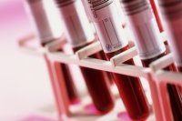 Symptómy a diagnostika leukémie (rakoviny krvi)