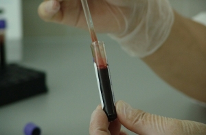 Rakovina pečene a vírusové hepatitídy (Hepatitída C, D a E)