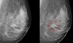 Tomosyntéza - 3D mamografia spoľahlivo odhalí rakovinu prsníka