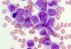 Leukémia - rakovina krvi