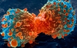 Najčastejšie nádorové ochorenia a ich prevencia