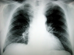 Aké druhy rakoviny pľúc poznáme ?